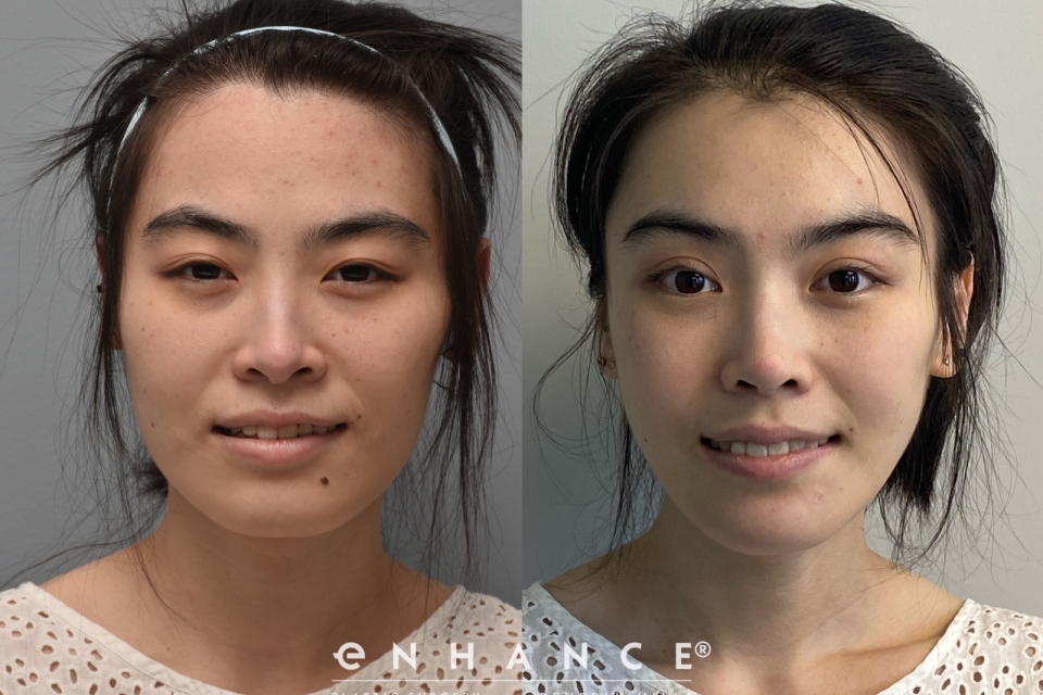 Cheek Reduction Photos Enhance Medical Center Beverly Hills Ca