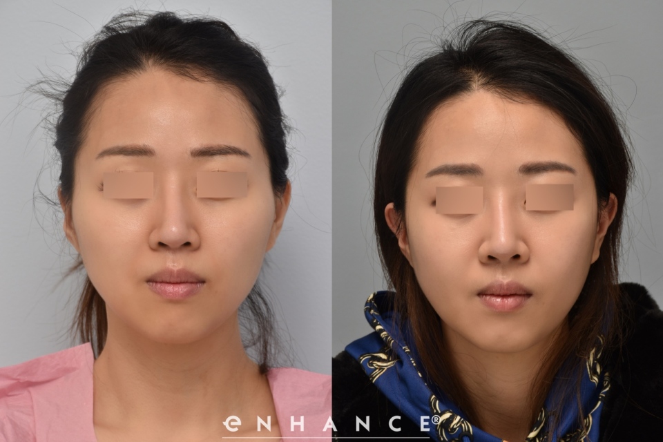 Cheek Reduction Photos Enhance Medical Center Beverly Hills Ca