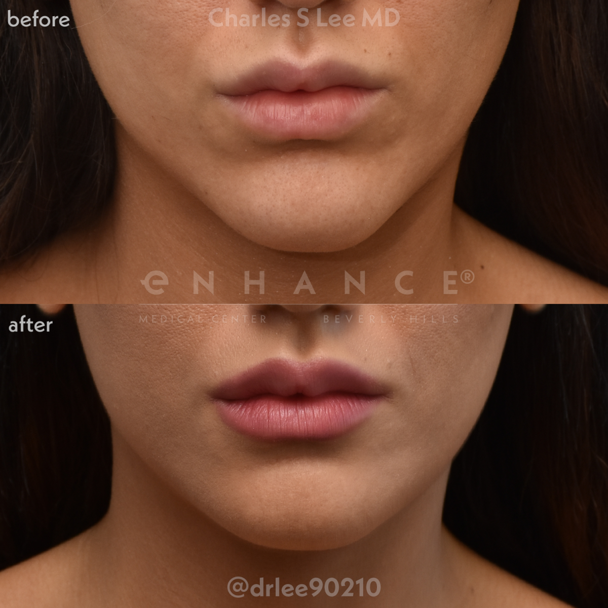 Jaw Augmentation Photos - Enhance® Medical Center | Beverly Hills, CA