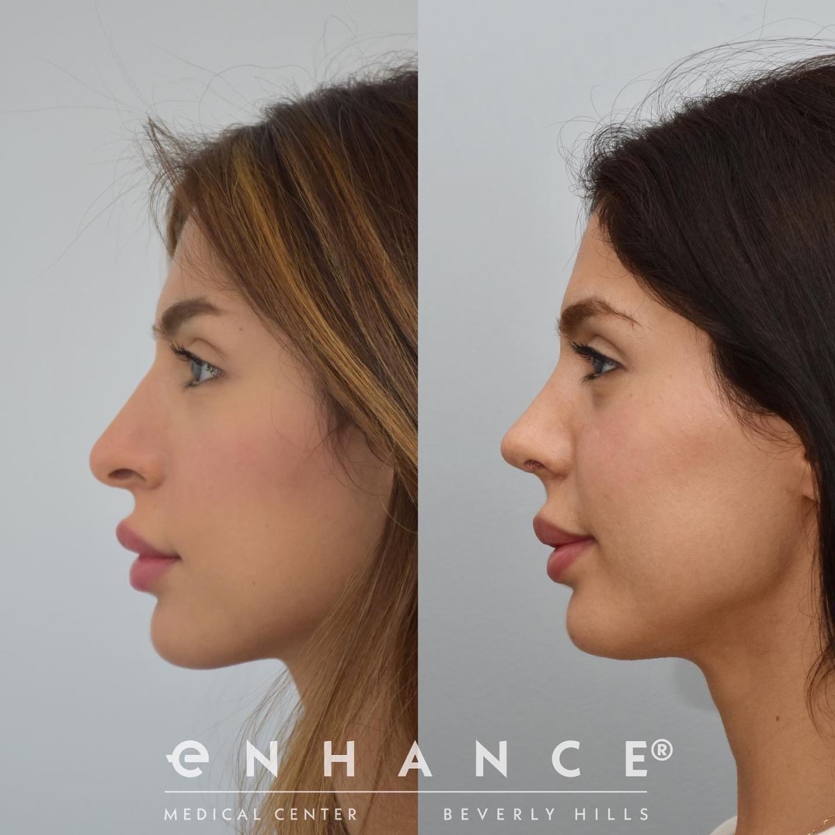 How Helping Charli's Nose Improved Her Breathing - Beverly Hills