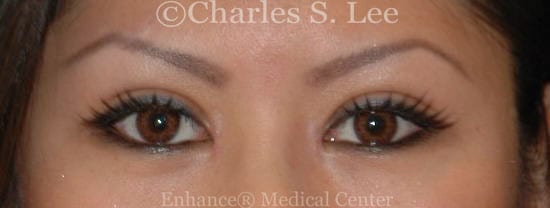 Asian double eyelid plastic surgery patient after 2