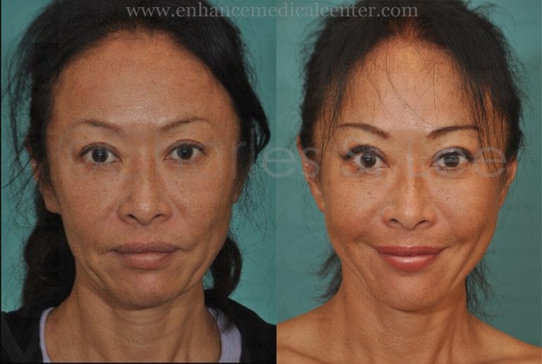 Facelift Archives | Charles S. Lee, MD