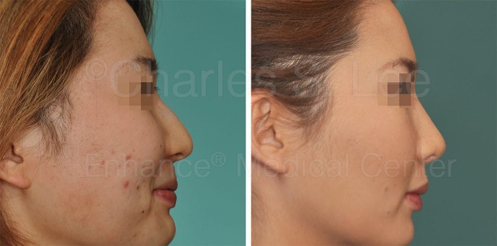 All Natural Rhinoplasty Using Ear Cartilage Charles S Lee Md 4552