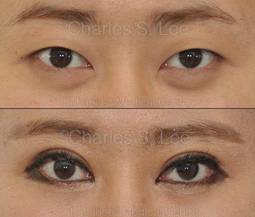 Natural double eyelid deals surgery