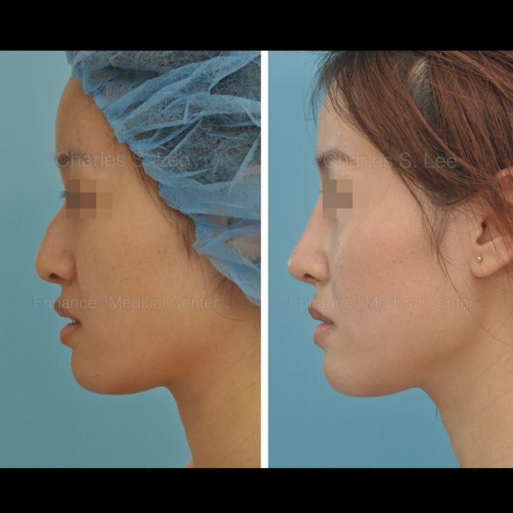 Balanced Rhinoplasty 