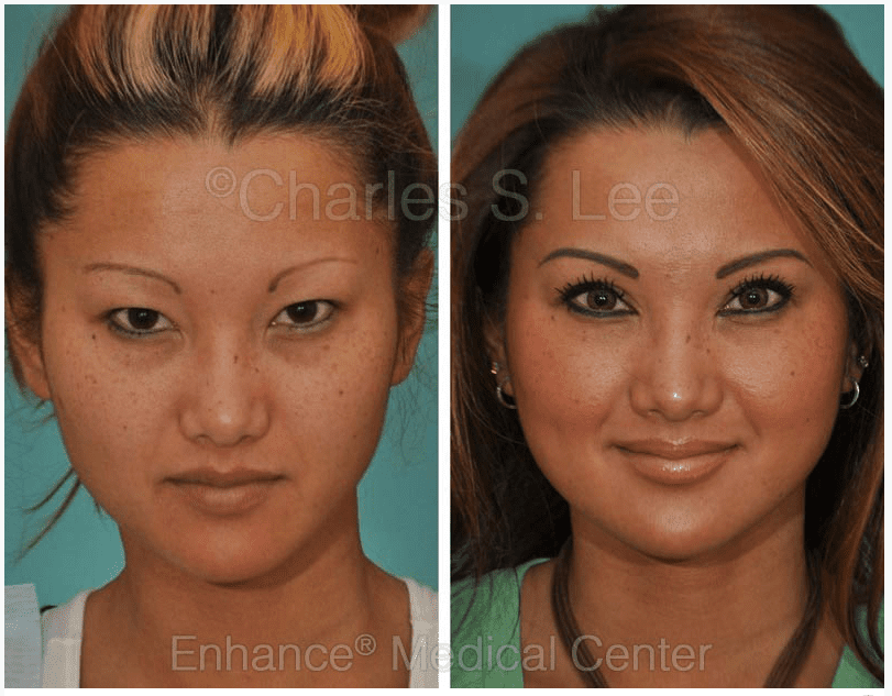 Asian Eyelid Surgery Can Give You The Look You Want Charles S Lee Md