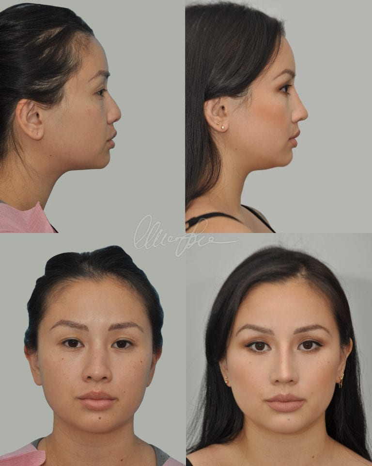 A Great Example Of Organic Asian Rhinoplasty Charles S Lee Md 8357