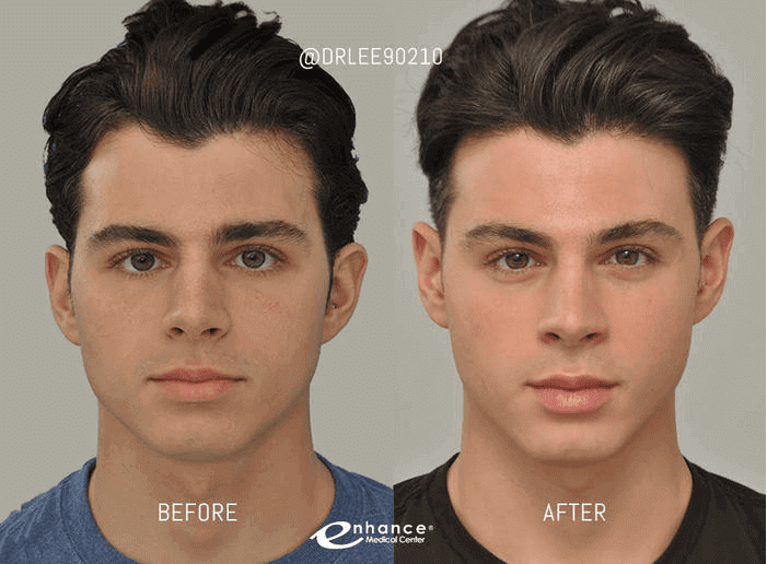 Cheek Reduction Results Male 