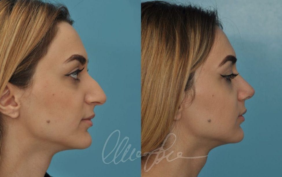 Patient 24 Rhinoplasty Before And After Enhance® Medical Center Beverly Hills Ca 9103