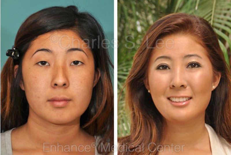 Brow Lift Surgery | Beverly Hills, CA | Charles S. Lee, MD