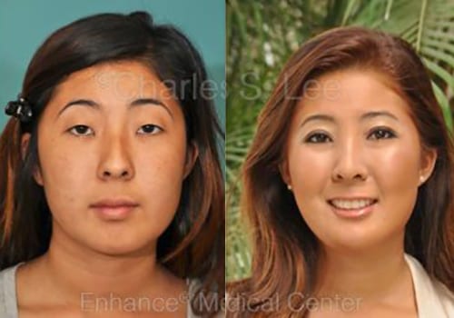 Before And After Gallery - Beverly Hills, CA | Dr. Charles Lee