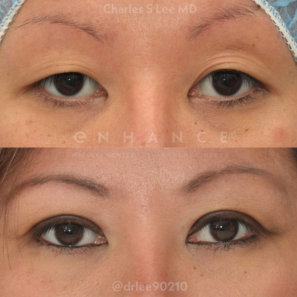 non incisional eyelid surgery